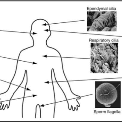 Symptoms of ciliopathies. Various ciliopathy phenotypes. (a) Normal ...