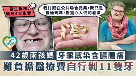 牙齒健康︳42歲兩孩媽牙齦感染含膿腫痛 難負擔醫療費自行剝11隻牙︳缺牙4大影響 晴報 健康 其他疾病 D211012