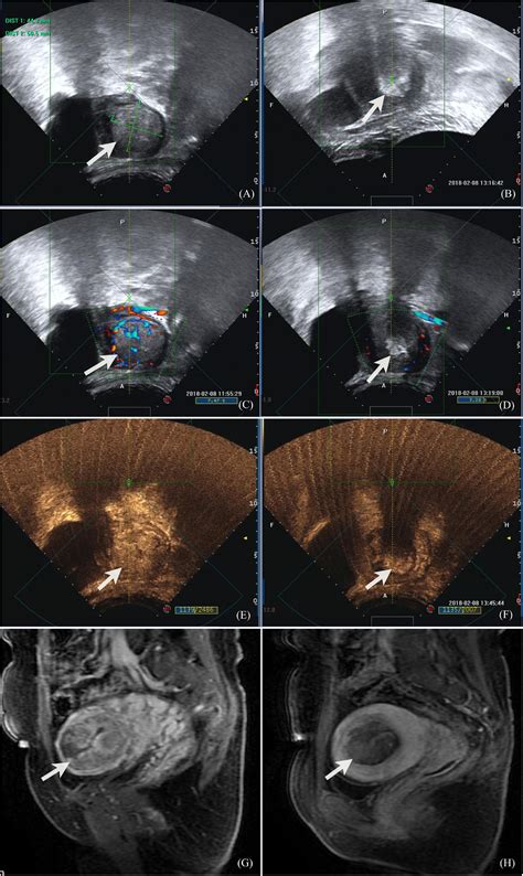 Frontiers Treatment Of Placenta Increta With High Intensity Focused