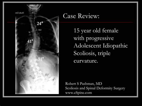 Case Review 20 15 Year Old Female With Adolescent Idiopathic