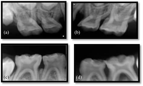 Peri Apical Radiographs Of All Quadrants Showing Enlarged Pulp Chambers