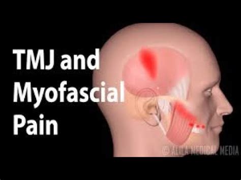 Tmj Exercises Stretches To Relieve Jaw Pain Youtube