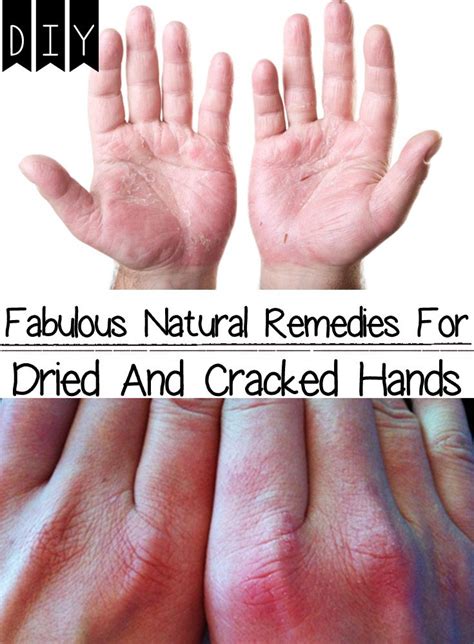 Home Remedies Dry Cracked Hands