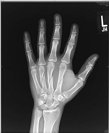 Metacarpal Fractures Hand Orthobullets