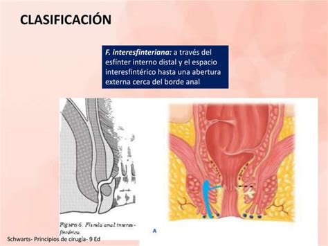 Abscesos Fistulas Anorectales Enfermedad Pilonidal Ppt