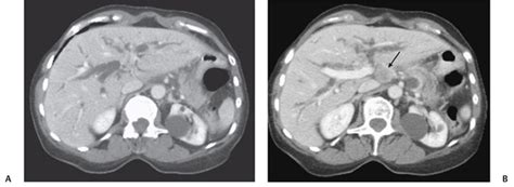 19 Mirizzi Syndrome | Radiology Key