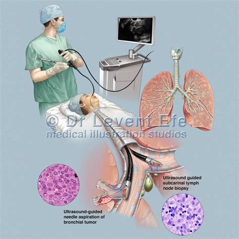 Endobronchial Ultrasound Guided Transbronchial Needle Aspiration Dr