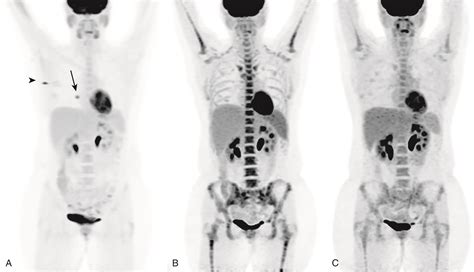 The Breast Cancer Survivor Breast Cancer Metastasis To Spine