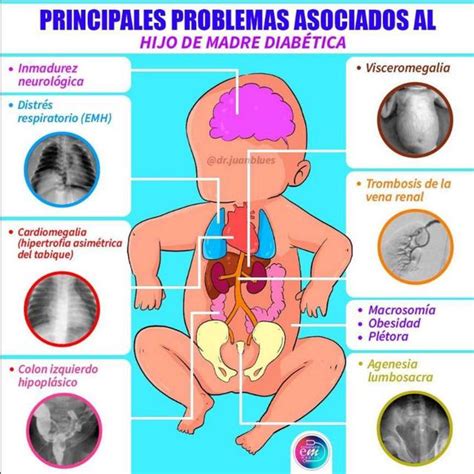 Problemas De Hijos De Madre Diabetica YUDOC ORG UDocz