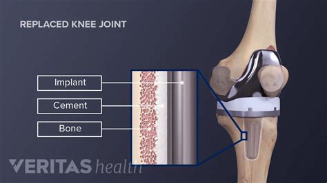 Knee Joint Replacement Devices