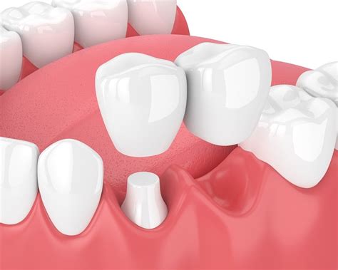 What Is A Dental Bridge ¿qué Es Un Puente Dental Mi Dental