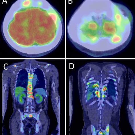 Fluorodeoxyglucose Positron Emission Tomography Of The Present Case