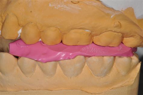 Restorative vs Diagnostic Dental Bite Records - Restorative Nation