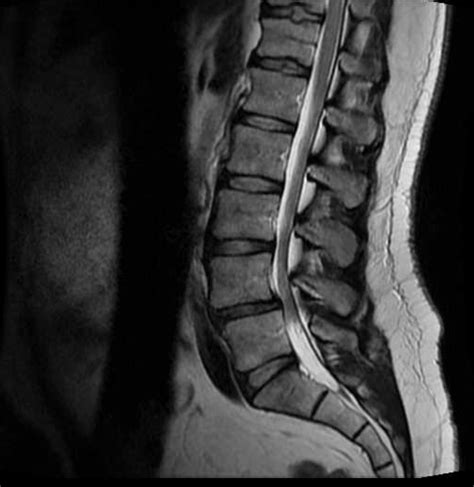 Low Back Pain - Lumbar Center