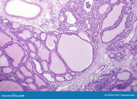 Endemic Goiter Light Micrograph Stock Image Image Of Deficiency