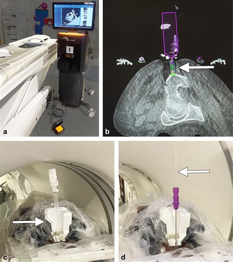 Feasibility And Safety Of Percutaneous Ct Guided Bone Biopsies In