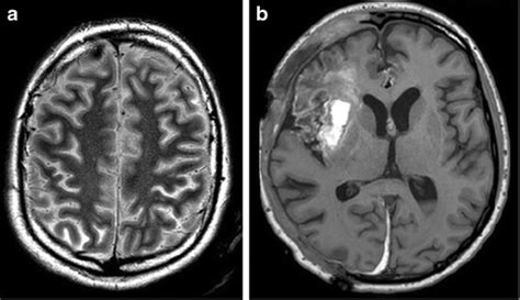 Secondary Cns Vasculitis In A 14 Year Old Girl With Systemic Lupus Download Scientific Diagram