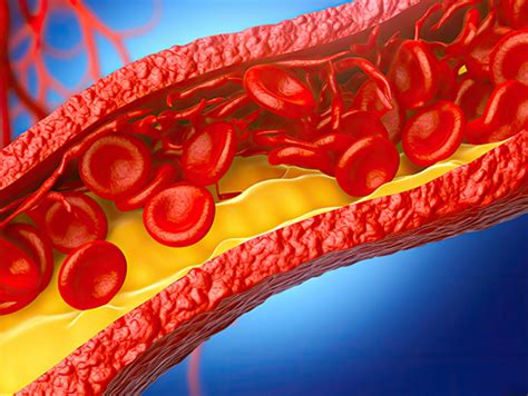 3D In Vitro Human Atherosclerosis Model For High Throughput Drug