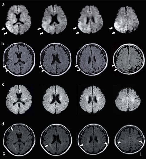 Figure 1 From Reversible Focal Cerebral Cortical Lesions In A Patient With Heat Stroke