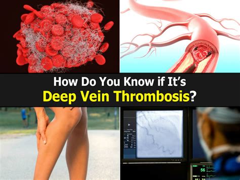 How Do You Know If Its Deep Vein Thrombosis