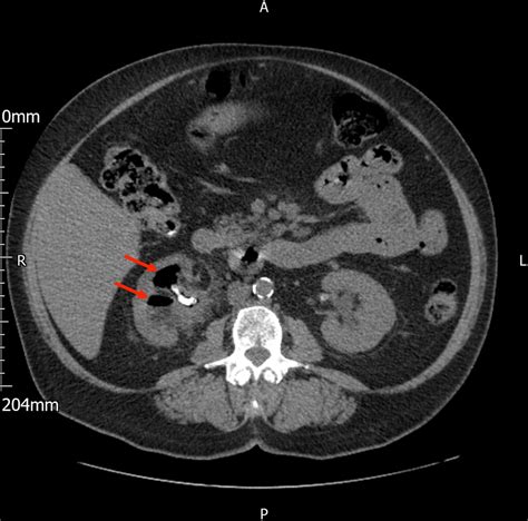 Asymptomatic Emphysematous Pyelitis—a Rare Clinical Entity Bmj Case Reports