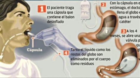 Elipse El Nuevo Bal N G Strico Para Combatir El Sobrepeso Sin Cirug A