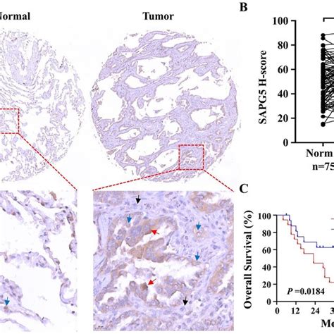 TMA IHC Staining Reveals Elevated Expression Of SPAG5 In LUAD Tumor