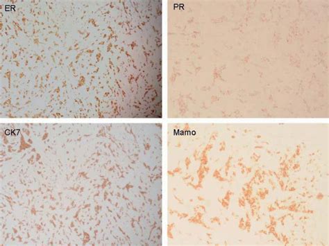 SciELO Brasil Cutaneous Involvement As The Initial Presentation Of