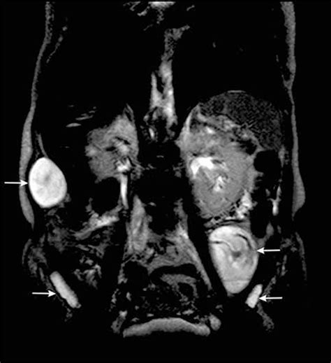 Scielo Brasil Association Between Atypical Parathyroid Adenoma And