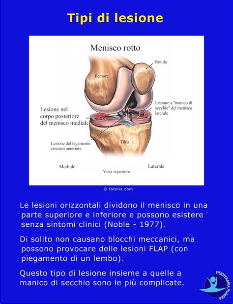 Lesione Al Menisco Le Cause I Sintomi E I Test