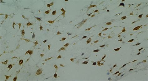 Immunohistochemistry Showed Strong Cytoplasmic And Nuclear Positivity