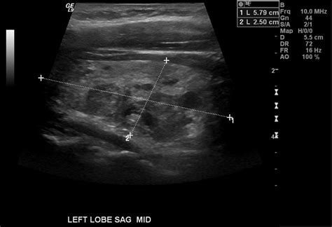 Thyroid Ultrasound