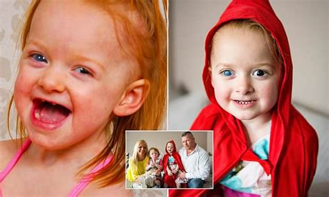 Manchester Girl Born Without Irises Finds It Painful To Face Sunlight