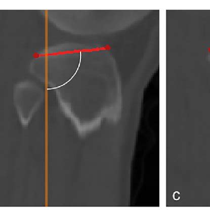 Measurement Of Sagittal Posterior Tibial Slope PTS A Confirmation Of