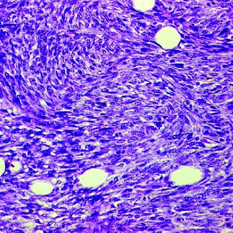 Histopathology Of The Tumor Showing Spindle Cells Arranged In Whorls