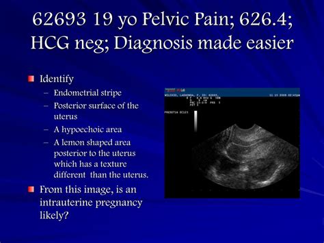 Ppt Transvaginal Gyn Ultrasound Replaces The Bimanual Pelvic Exam