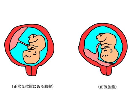 ハイリスク妊娠の一つである前置胎盤について 市川市の産婦人科「佐野産婦人科」