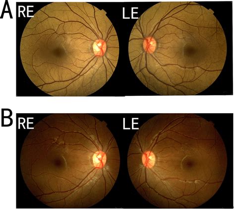 Dark Adaptation Test Of The Patient A Color Fundus Photography Of The