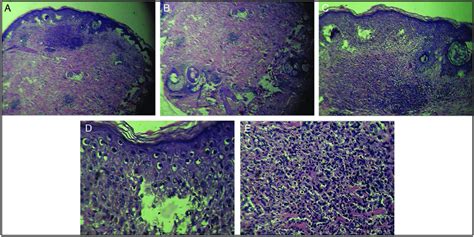 A Hande 4x Basket Weave Hyperkeratosis Overlying Acanthotic