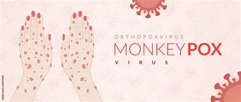 Vecteur Stock Monkeypox Virus Banner For Awareness And Alert Against