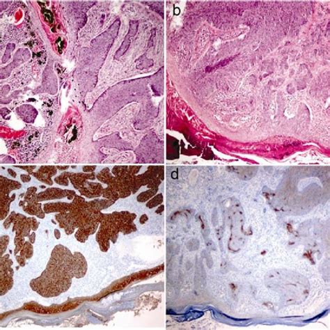 Basal cell carcinoma (BCC): Focal ulcerated, nodular lesions are ...