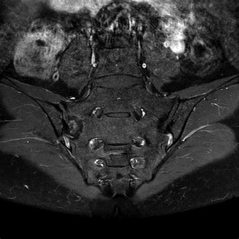 Magnetic Resonance Imaging Of The Sacroiliac Si Joint Large Download Scientific Diagram