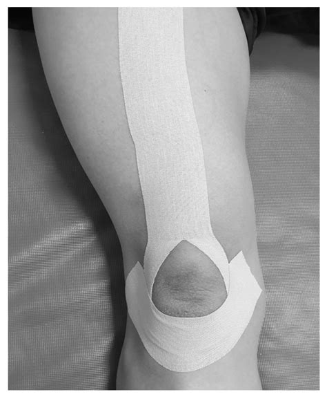 Patellofemoral Pain Syndrome Taping