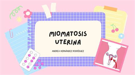 Miomatosis Uterina Andrea Hern Ndez Udocz