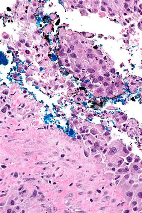 Urothelial Carcinoma Libre Pathology