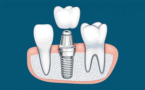 A Comprehensive Guide To Caring For Your Dental Implants