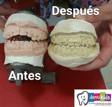 C Mo Saber Que Tu Hijo Necesita Aparato Cl Nica Dental De Ni Os Y