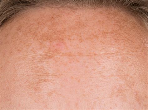 Chloasma Melasma Pictures Photos