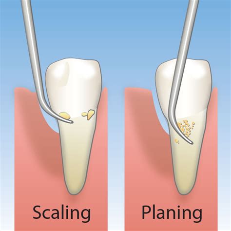 How Periodontal Scaling And Root Planing Can Transform Your Smile Mly