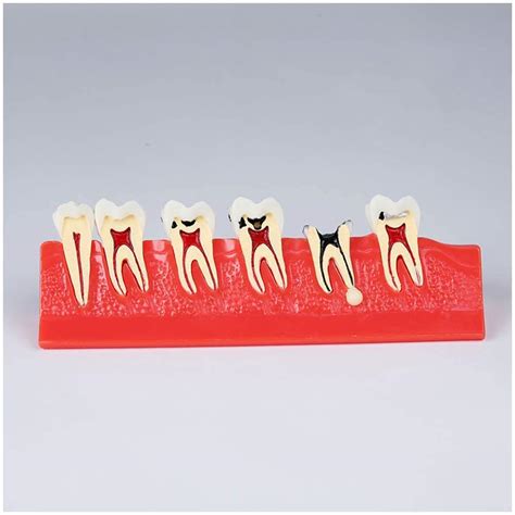 Buy Dental Caries Template Teeth Anatomy Model Carry Development